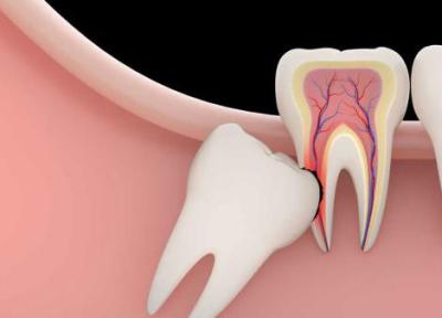 عوارض ناشی از دندان های عقل نهفته